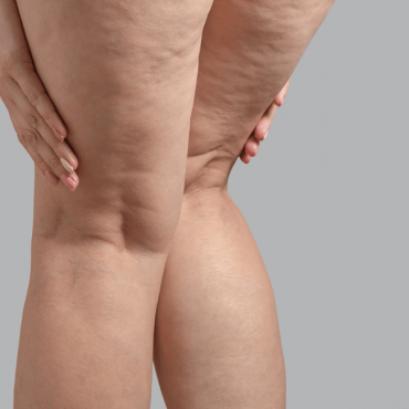 Tratamento para Lipedema em Águas Claras