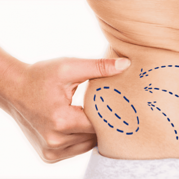 Hidrolipo em Águas Claras