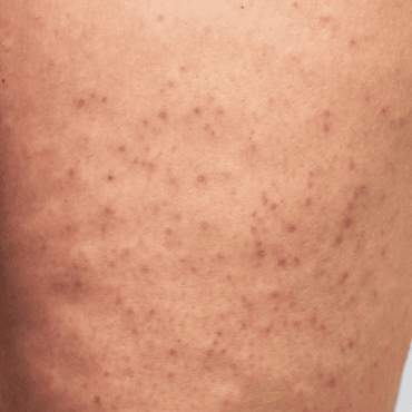 Tratamento para Foliculite em Águas Claras