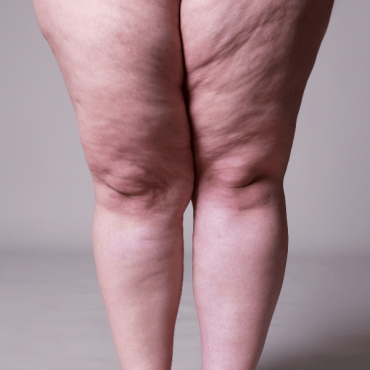 Enzimas para Lipedema em Águas Claras
