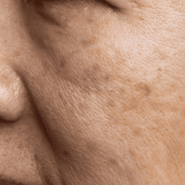 Melasma e Manchas em Águas Claras