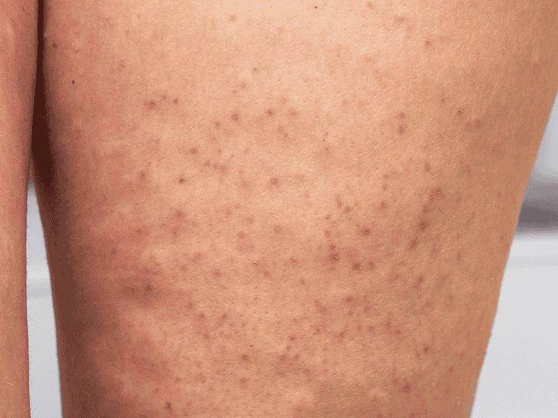 Tratamento para Foliculite em Águas Claras